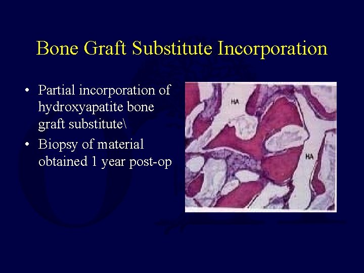 Bone Graft Substitute Incorporation • Partial incorporation of hydroxyapatite bone graft substitute • Biopsy