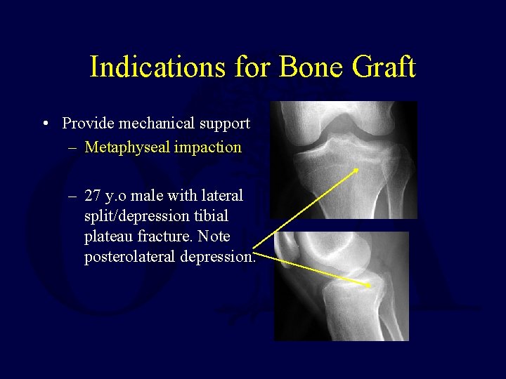 Indications for Bone Graft • Provide mechanical support – Metaphyseal impaction – 27 y.