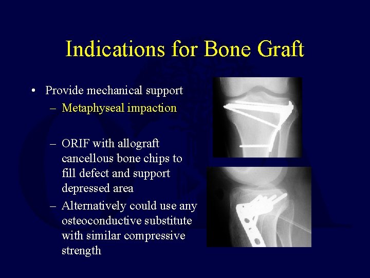 Indications for Bone Graft • Provide mechanical support – Metaphyseal impaction – ORIF with