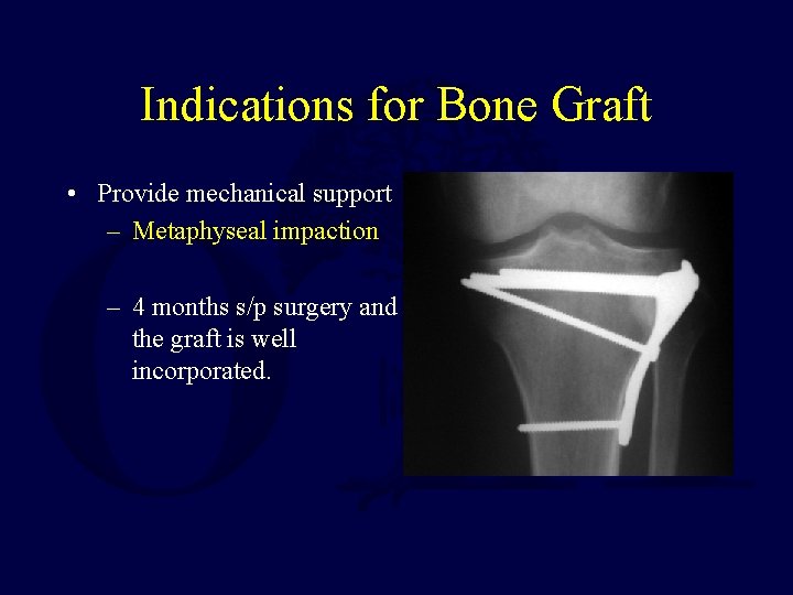 Indications for Bone Graft • Provide mechanical support – Metaphyseal impaction – 4 months