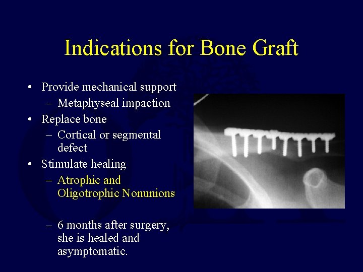 Indications for Bone Graft • Provide mechanical support – Metaphyseal impaction • Replace bone