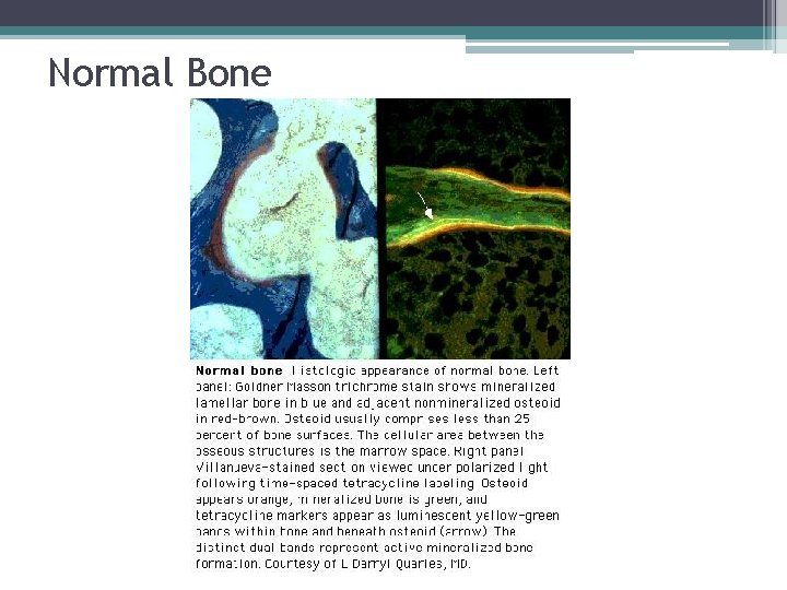 Normal Bone 
