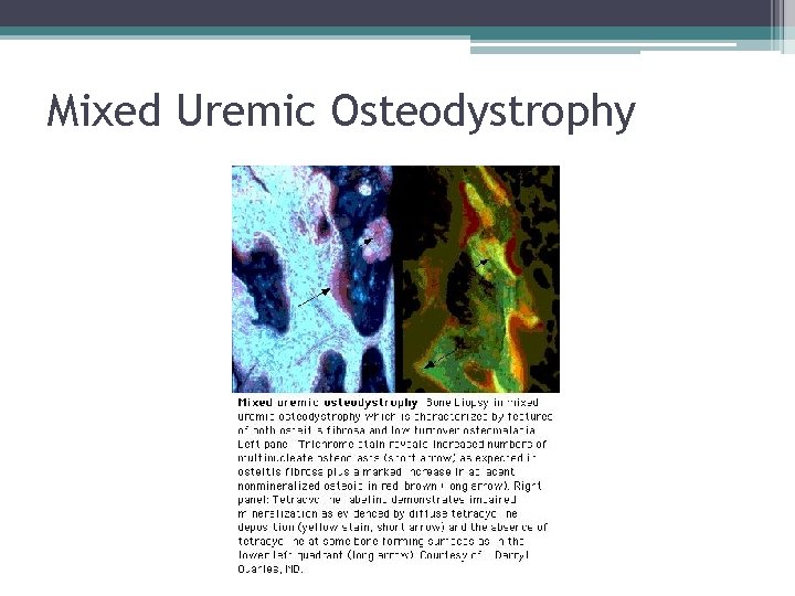 Mixed Uremic Osteodystrophy 