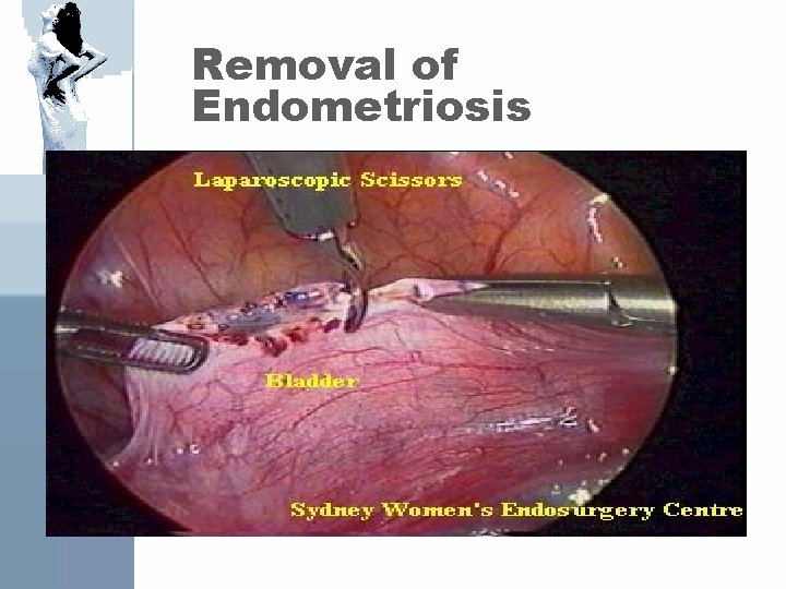 Removal of Endometriosis 