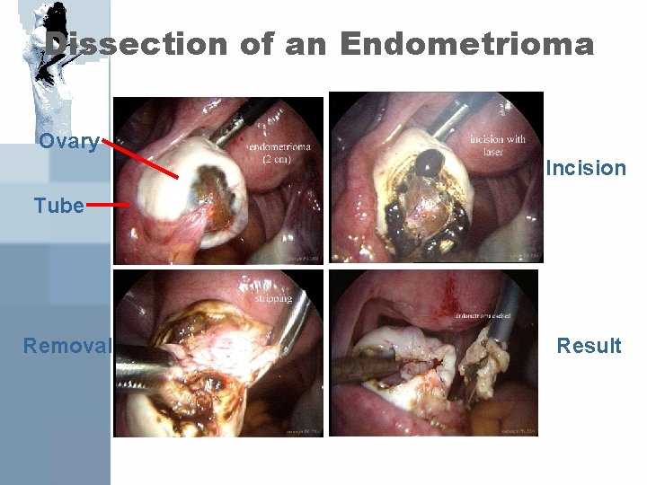 Dissection of an Endometrioma Ovary Incision Tube Removal Result 