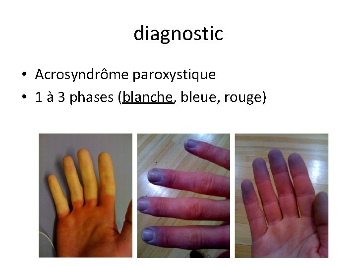 diagnostic • Acrosyndrôme paroxystique • 1 à 3 phases (blanche, bleue, rouge) 