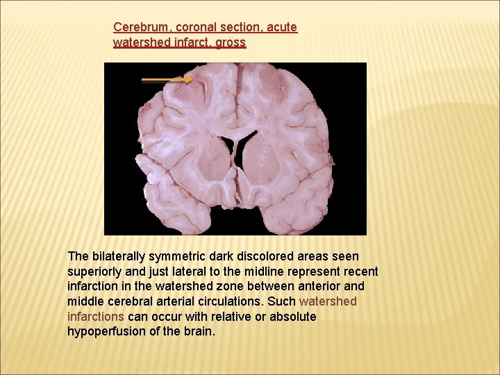 Cerebrum, coronal section, acute watershed infarct, gross The bilaterally symmetric dark discolored areas seen