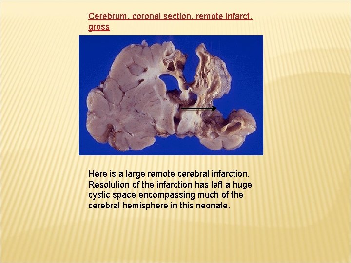 Cerebrum, coronal section, remote infarct, gross Here is a large remote cerebral infarction. Resolution