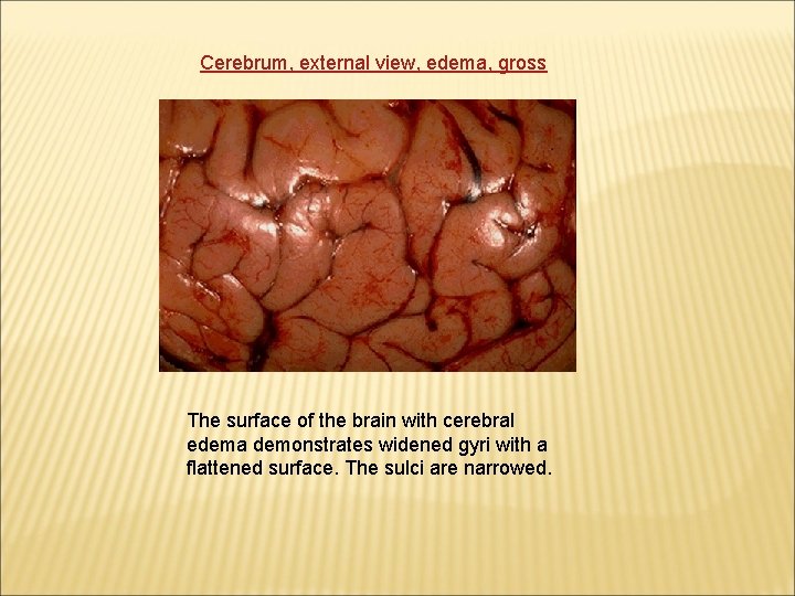 Cerebrum, external view, edema, gross The surface of the brain with cerebral edema demonstrates