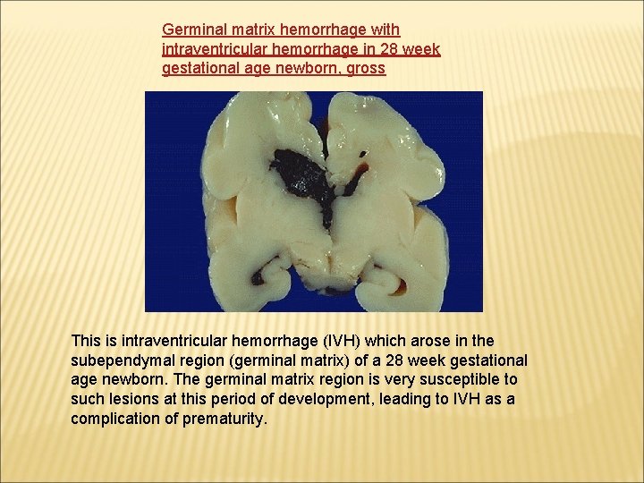 Germinal matrix hemorrhage with intraventricular hemorrhage in 28 week gestational age newborn, gross This