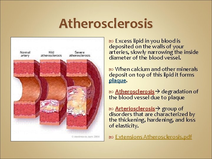 Atherosclerosis Excess lipid in you blood is deposited on the walls of your arteries,