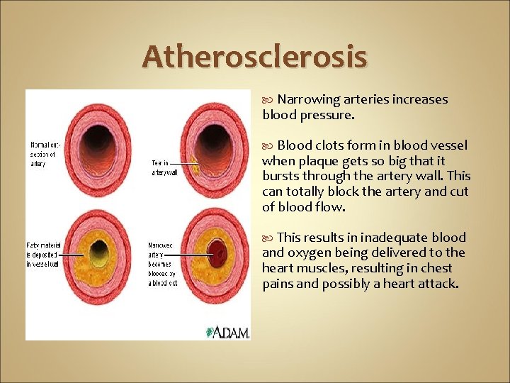 Atherosclerosis Narrowing arteries increases blood pressure. Blood clots form in blood vessel when plaque