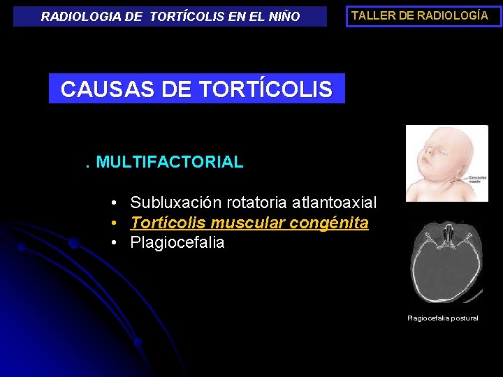 RADIOLOGIA DE TORTÍCOLIS EN EL NIÑO TALLER DE RADIOLOGÍA CAUSAS DE TORTÍCOLIS. MULTIFACTORIAL •