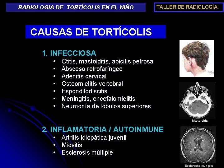 RADIOLOGIA DE TORTÍCOLIS EN EL NIÑO TALLER DE RADIOLOGÍA CAUSAS DE TORTÍCOLIS 1. INFECCIOSA