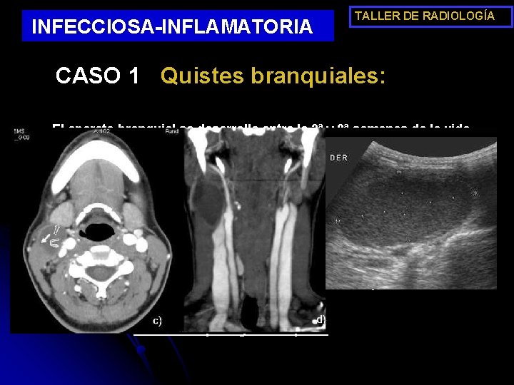 INFECCIOSA-INFLAMATORIA TALLER DE RADIOLOGÍA CASO 1 Quistes branquiales: • El aparato branquial se desarrolla