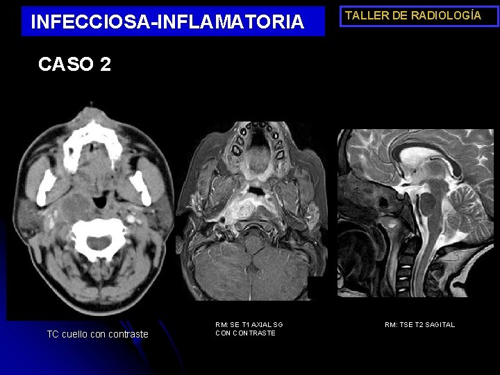 TALLER DE RADIOLOGÍA INFECCIOSA-INFLAMATORIA CASO 2 B TC cuello contraste RM: SE T 1