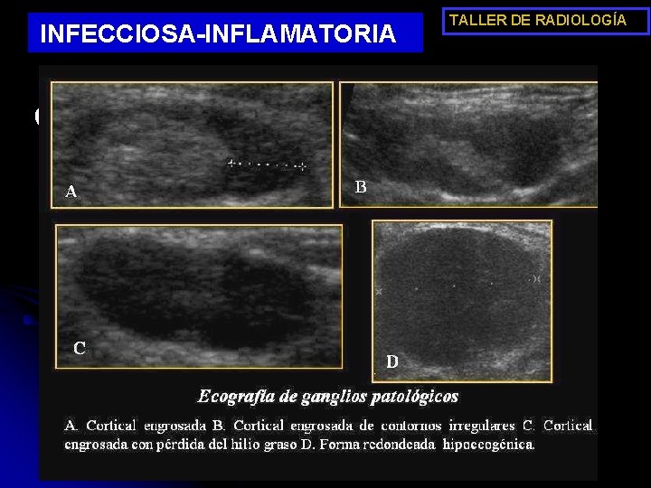 INFECCIOSA-INFLAMATORIA TALLER DE RADIOLOGÍA CASO 3 l Signos clínicos sospechosos de malignidad: l l