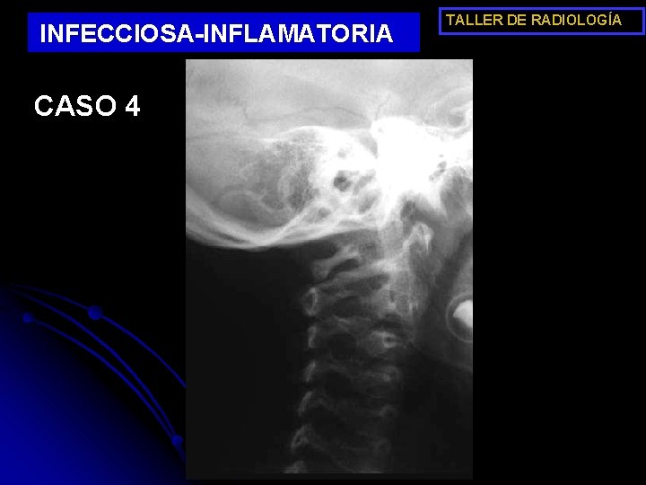 INFECCIOSA-INFLAMATORIA CASO 4 TALLER DE RADIOLOGÍA 