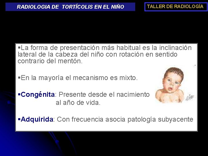 RADIOLOGIA DE TORTÍCOLIS EN EL NIÑO TALLER DE RADIOLOGÍA §La forma de presentación más