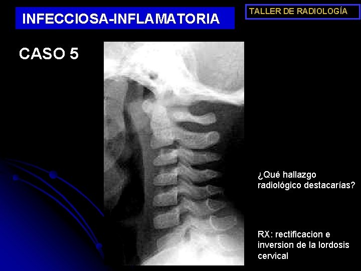 INFECCIOSA-INFLAMATORIA TALLER DE RADIOLOGÍA CASO 5 ¿Qué hallazgo radiológico destacarías? RX: rectificacion e inversion