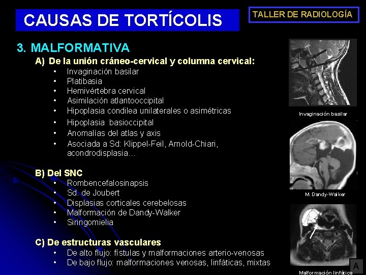 CAUSAS DE TORTÍCOLIS TALLER DE RADIOLOGÍA 3. MALFORMATIVA A) De la unión cráneo-cervical y