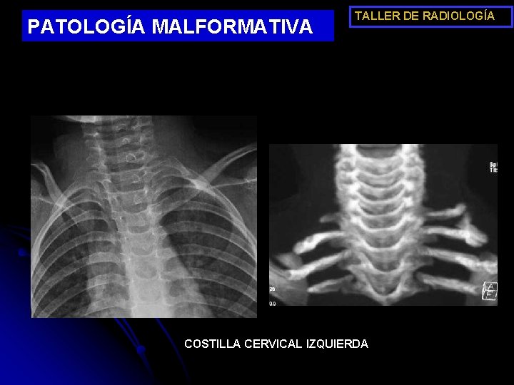 PATOLOGÍA MALFORMATIVA TALLER DE RADIOLOGÍA COSTILLA CERVICAL IZQUIERDA 