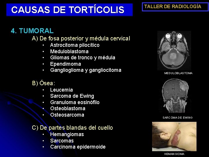 CAUSAS DE TORTÍCOLIS TALLER DE RADIOLOGÍA 4. TUMORAL A) De fosa posterior y médula