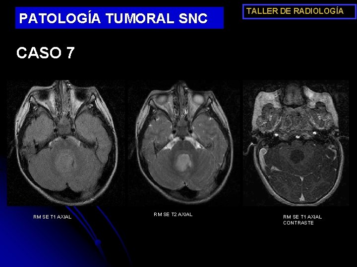 PATOLOGÍA TUMORAL SNC TALLER DE RADIOLOGÍA CASO 7 RM SE T 1 AXIAL RM