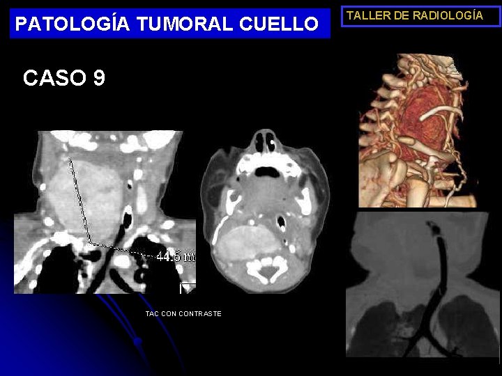 PATOLOGÍA TUMORAL CUELLO CASO 9 TAC CONTRASTE TALLER DE RADIOLOGÍA 