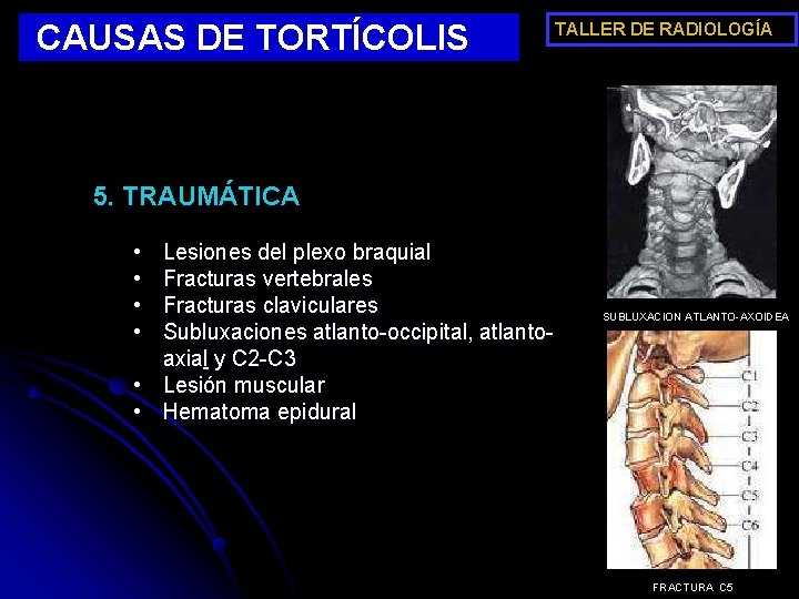 CAUSAS DE TORTÍCOLIS TALLER DE RADIOLOGÍA 5. TRAUMÁTICA • • Lesiones del plexo braquial