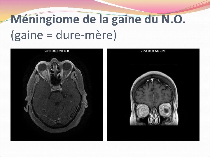 Méningiome de la gaine du N. O. (gaine = dure-mère) 