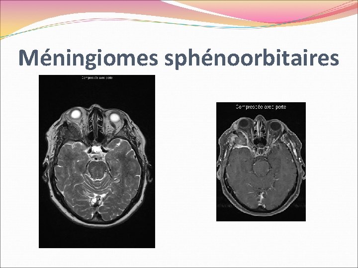 Méningiomes sphénoorbitaires 