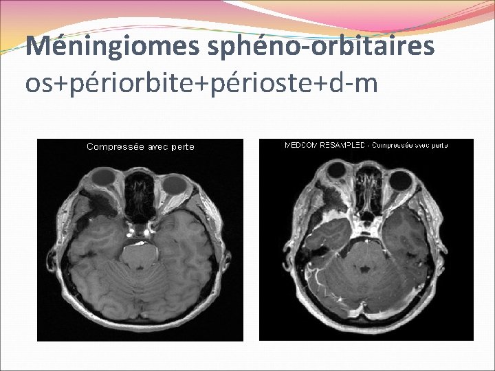 Méningiomes sphéno-orbitaires os+périorbite+périoste+d-m 