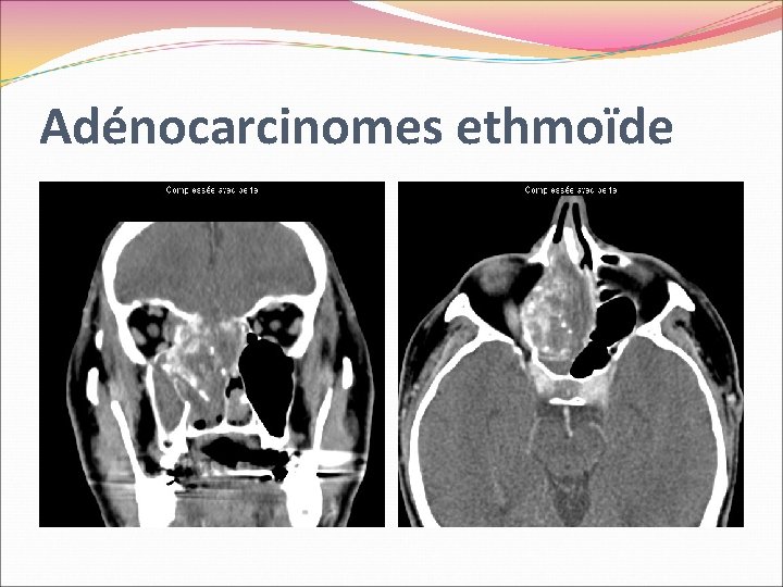 Adénocarcinomes ethmoïde 