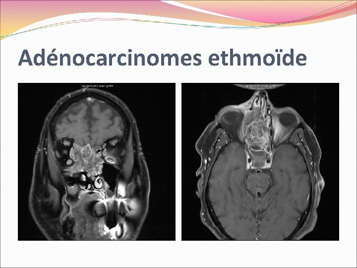 Adénocarcinomes ethmoïde 