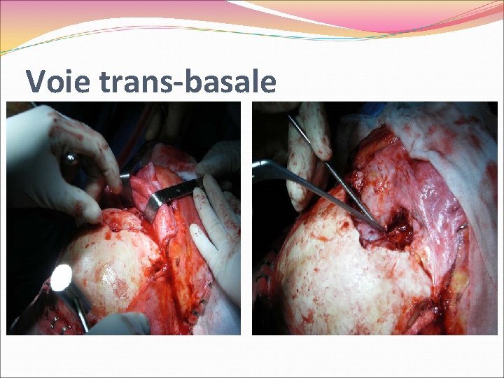 Voie trans-basale 