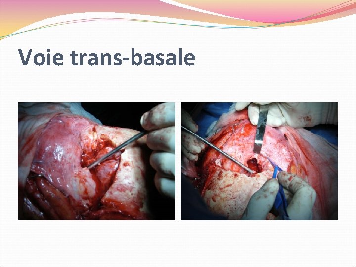 Voie trans-basale 