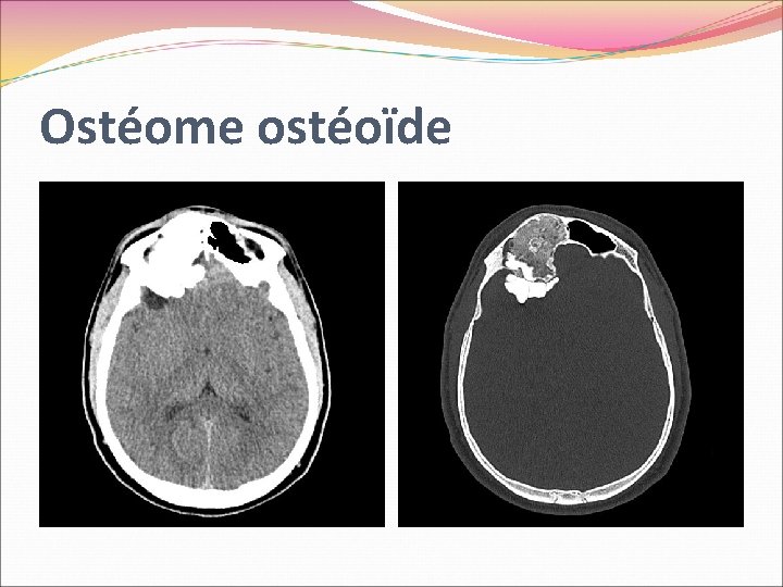 Ostéome ostéoïde 