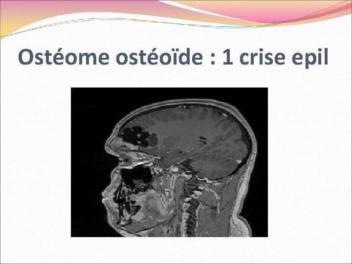 Ostéome ostéoïde : 1 crise epil 