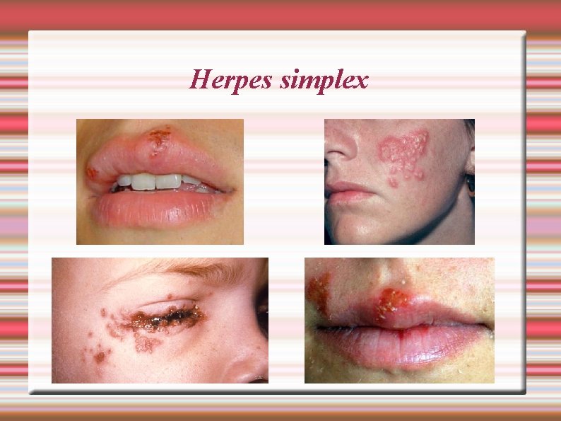 Herpes simplex 