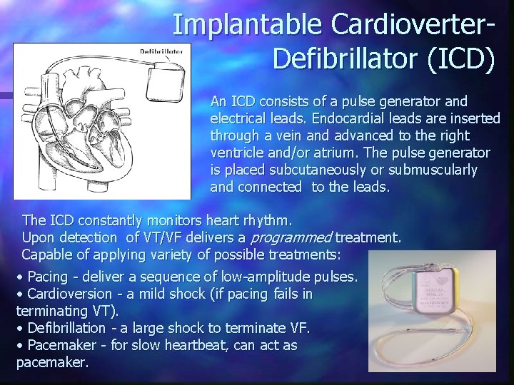Implantable Cardioverter. Defibrillator (ICD) An ICD consists of a pulse generator and electrical leads.