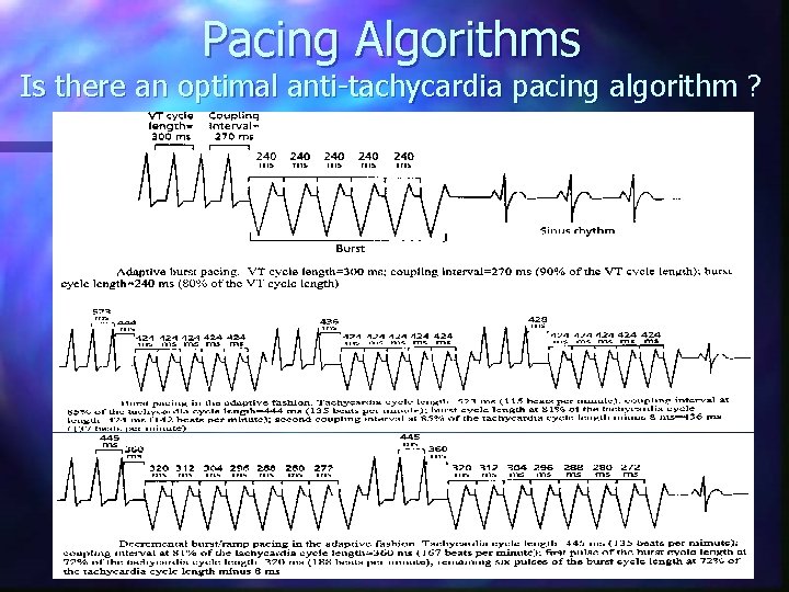 Pacing Algorithms Is there an optimal anti-tachycardia pacing algorithm ? 