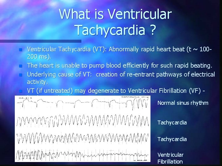 What is Ventricular Tachycardia ? n n Ventricular Tachycardia (VT): Abnormally rapid heart beat