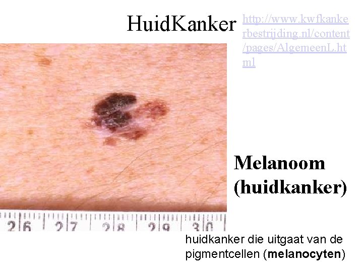 Huid. Kanker http: //www. kwfkanke rbestrijding. nl/content /pages/Algemeen. L. ht ml Melanoom (huidkanker) huidkanker