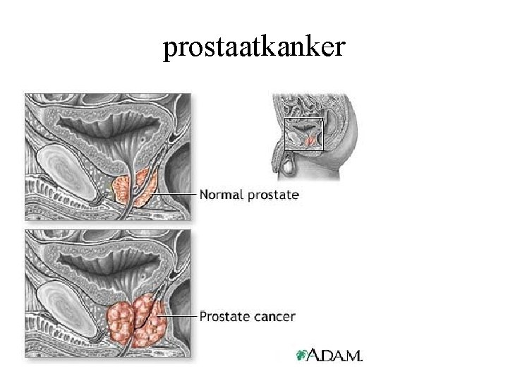 prostaatkanker 
