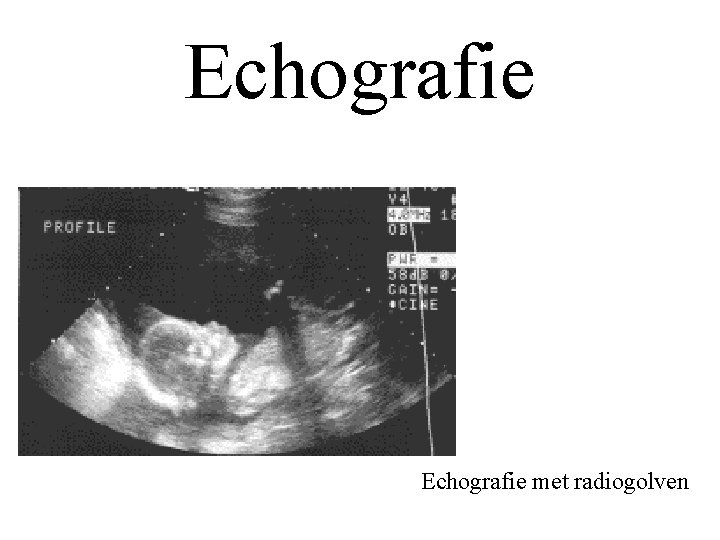 Echografie met radiogolven 