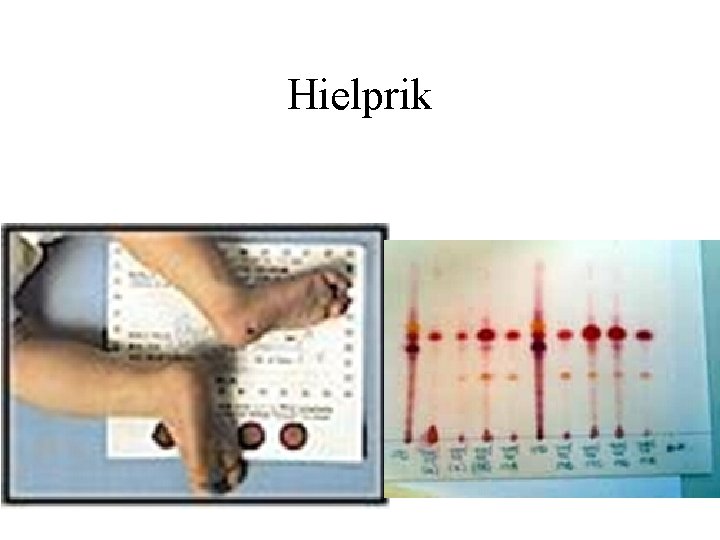 Hielprik 