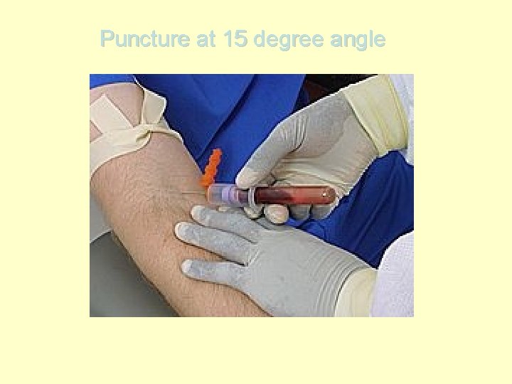 Puncture at 15 degree angle 