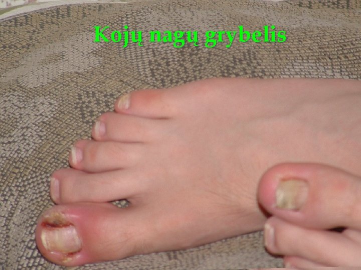 Kojų nagų grybelis 