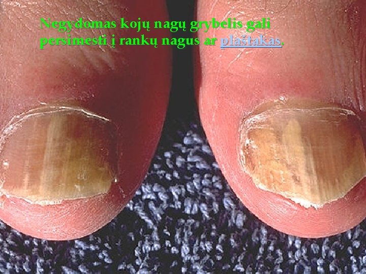 Negydomas kojų nagų grybelis gali persimesti į rankų nagus ar plaštakas. 